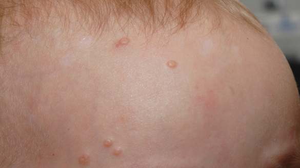 Molluskat (Molluscum contagiosum)